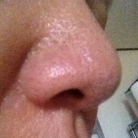 酒さ 肌断食６年目の肌vol.447