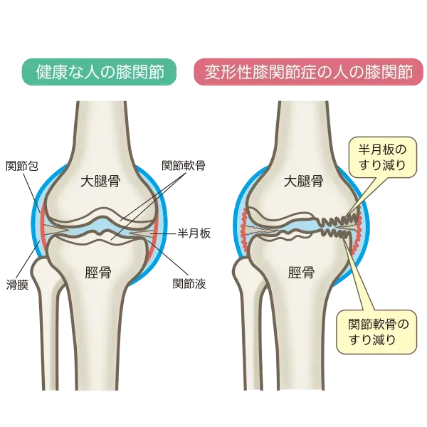 膝裏が痛いのはなぜ？痛みや腫れの原因と自分で行える治し方 ストレッチ等 を解説 - 株式会社リハサク