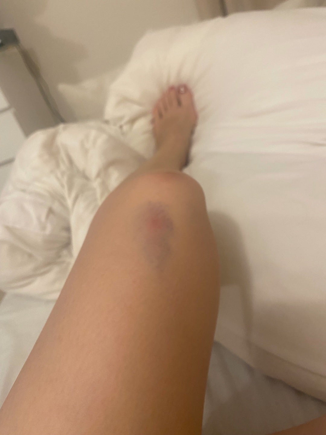 膝をぶつけた後の痛みが取れない膝痛のツボツボネット 鍼灸の症例が検索できるツボ辞典