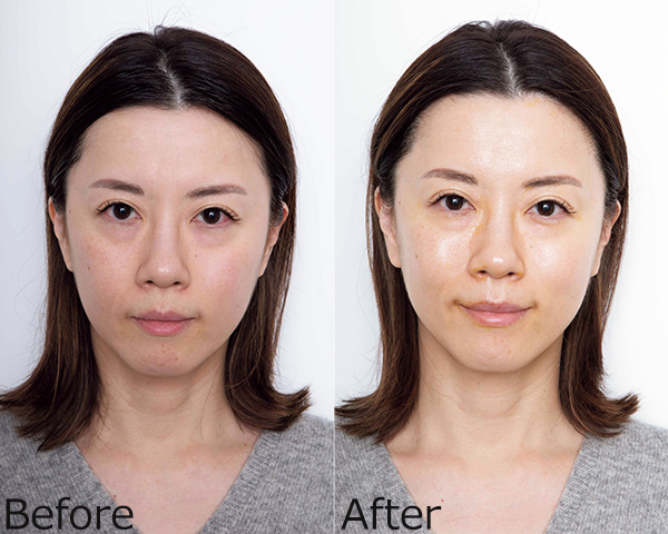 肌悩みが増える40代、初めて「美容医療」にトライするならどれ？ に答えます！ 友利新的アンチエイジングBeauty_Vol.6美的.com