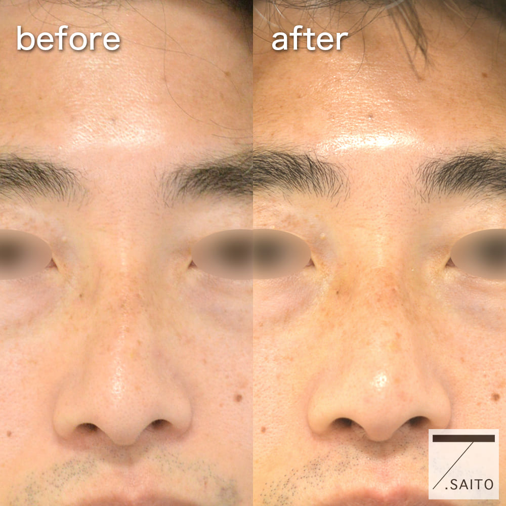 初心者向け 実は重要なパーツ！おさらいしたい鼻の描き方まとめ！MediBang Paint – 無料のイラスト・マンガ制作ツール