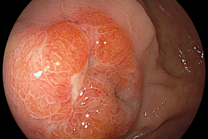 大腸ポリープ切除について浜本クリニック