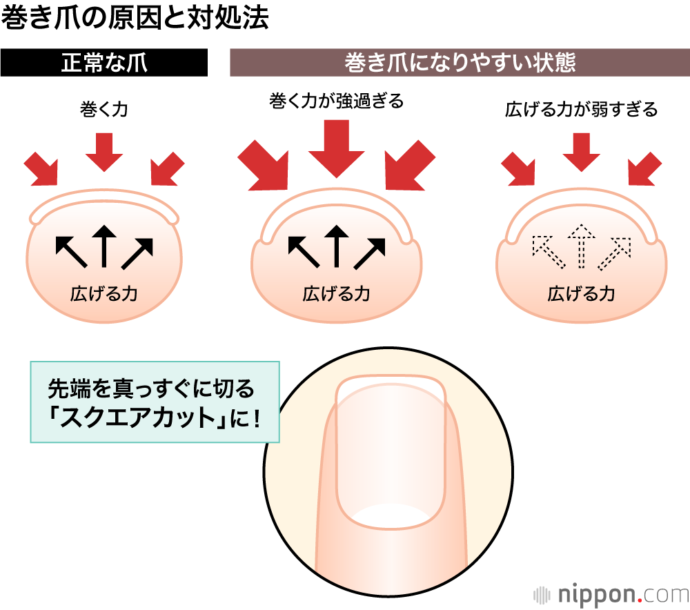 なぜ「巻き爪」になるの？ ポイントは爪の切り方名医のTHE太鼓判！TBSテレビ