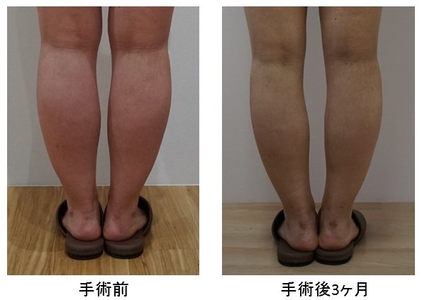 下腿の脂肪吸引 8ヶ月 25歳 154cm 63kg脂肪吸引院長 内浦康信ブログ脂肪吸引ならクリニック日比谷
