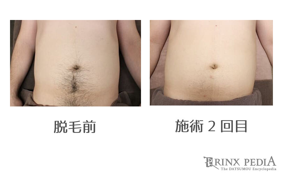 へそ回りの毛の脱毛範囲ってどこまでなの？ - 全身脱毛の料金が安い人気サロン・おすすめ脱毛器口コミ エピトーク