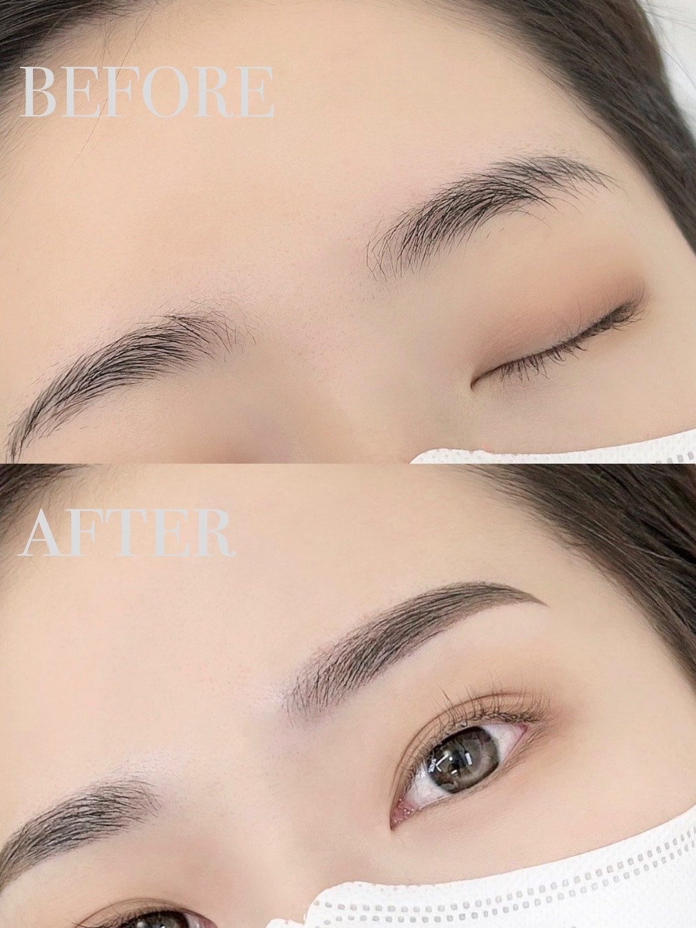 20年前の眉アートメイクを除去した結果！1回のレーザー治療でこんなに綺麗になりました肌と歯のクリニック 東京ベイ幕張千葉 美容皮膚科