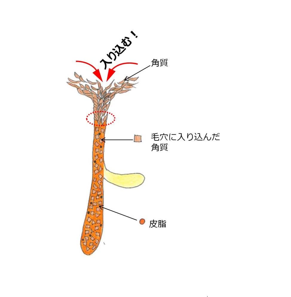 放っておくとニキビの温床に！あごの白いぶつぶつの対処法うる肌シェービング