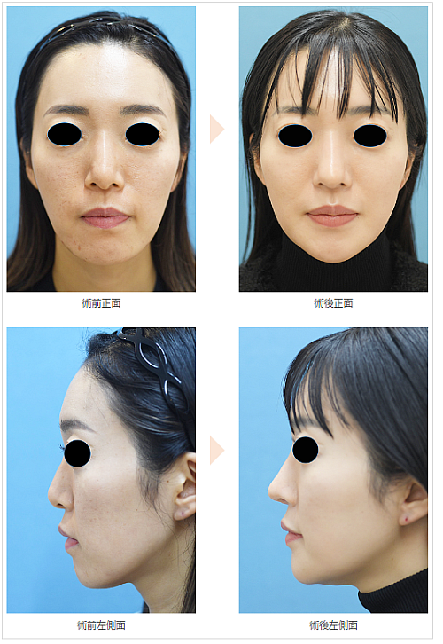 韓国NANA美容整形外科 顎先形成