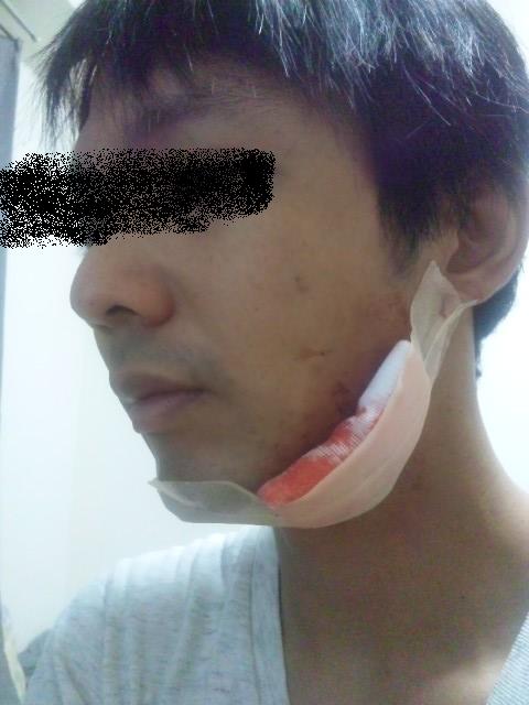 歯科 Q&A : 「虫歯での顔の腫れについて」病院口コミ検索カル