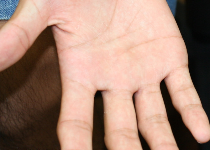 いぼ野田市 小児科 千葉県 こどもの花粉症 こどもの漢方 喘息 アトピー性皮膚炎 アレルギー 結節性痒疹 たんぽぽこどもクリニック