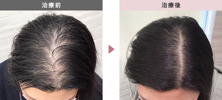 ミノキシジルは効果ない？外用薬・内服薬の正しい使い方、時間・費用について教えますAGA治療専門「男たちの美容外科」 福岡・広島