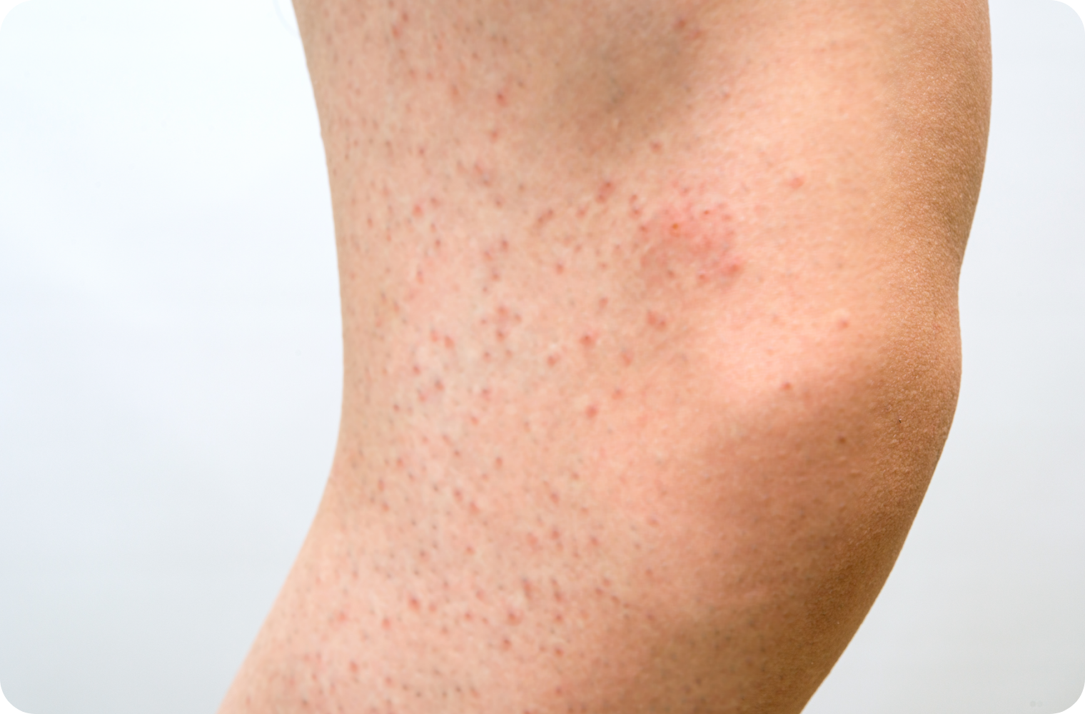 ヒゲの永久脱毛で後悔しないためには？効果・費用・デメリットまで徹底解説The Style Dictionary