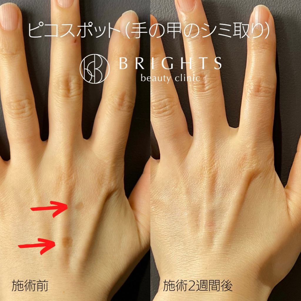 手の甲のシミ取り治療とは？シミの原因やレーザー治療の種類・予防法を解説美容施術トピック医療脱毛・シミ 治療・メディカルア―トメイクなら三鷹駅1分の三鷹ヒロクリニック