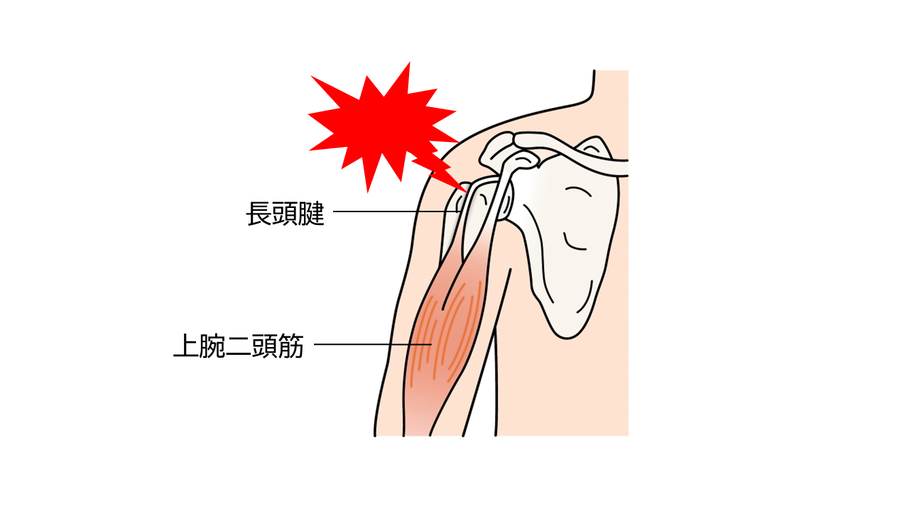 ドケルバン病 - 大阪 ばね指の手術・治療 医療法人 古東整形外科