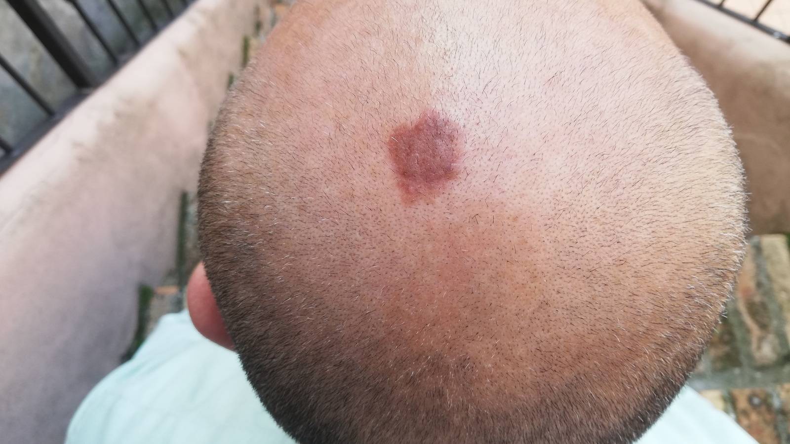 頭皮の赤い出来物の写真・画像素材-Snapmart スナップマート