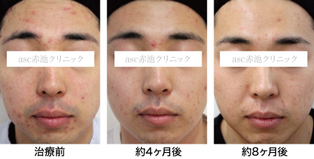 頭皮ニキビ、やってはいけない12のこと。その原因と対策摩耶堂製薬 ロート製薬グループ