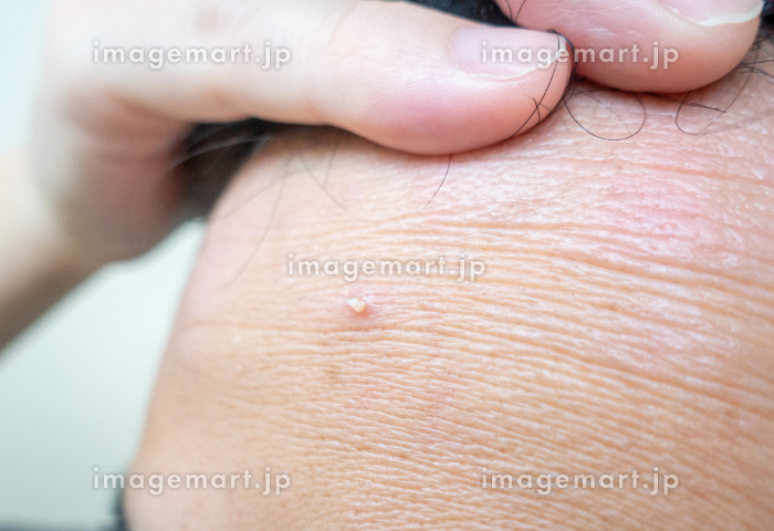 10日ぶりの鼻パック。角栓もしっかりと詰まってました 。もちろんオロナインも使用マイクロスコープ- YouTube