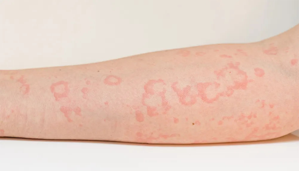 蕁麻疹の原因とは？症状や治療法について解説ヒロオカクリニック