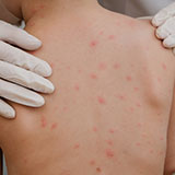 脂漏性皮膚炎』の原因・症状・治療法 症例画像 田辺三菱製薬ヒフノコトサイト