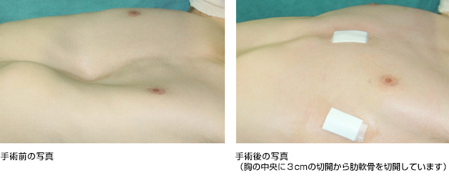 あかちゃん、子どものおっぱいがふくらんできた 小児の乳腺 にゅうせん の病気国分寺市の小児科 小森こどもクリニック