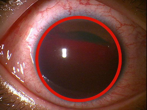 症例紹介 1歳児のまぶたの割創をなつい式湿潤療法とテーピングで治療縫わずに綺麗に治癒