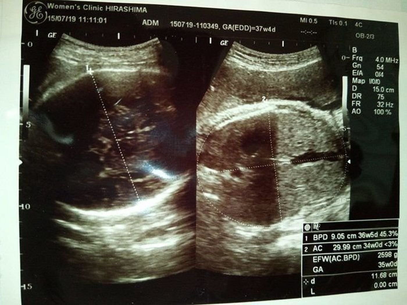 妊娠36週 赤ちゃんのエコー写真・超音波写真まとめたまひよ