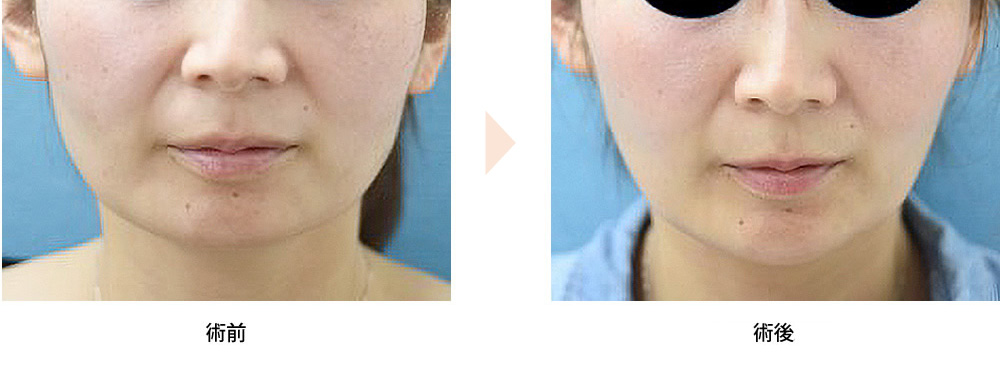 生まれつきの下膨れ顔を小顔に改善する方法輪郭形成・小顔整形 コラム池袋の小顔整形・顔痩せ・輪郭整形みずほクリニック