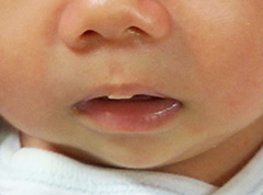 口内炎と口唇ヘルペスの違い赤羽の歯医者赤羽歯科赤羽診療所