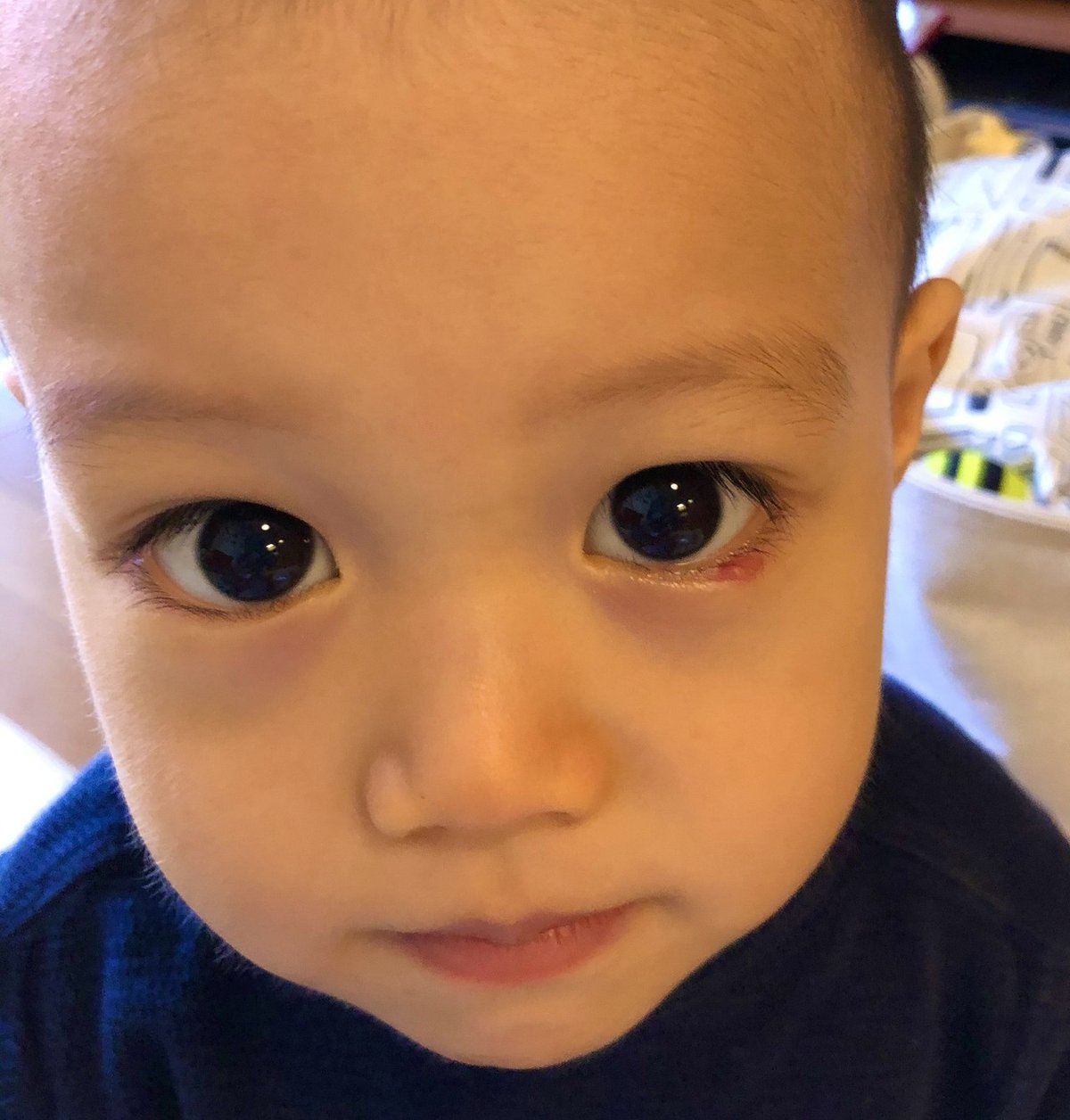 子供の霰粒腫の切開 - 溜池山王 伊藤眼科