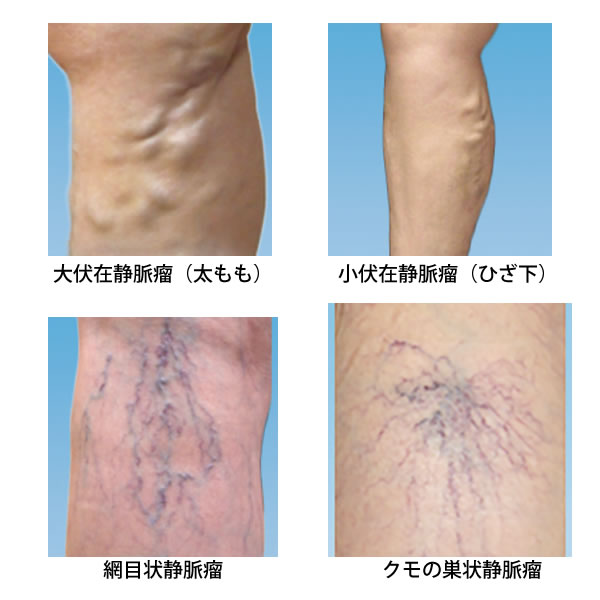 脳動脈瘤と頸動脈狭窄症」