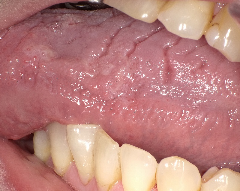 病気サイン？舌がひび割れる4つの原因。溝状舌・ドライマウスはどう治す？病院は何科？Medicalook メディカルック