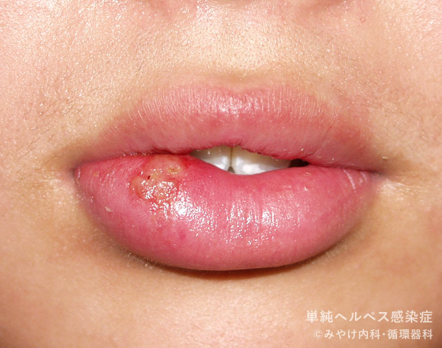 口唇ヘルペス 単純ヘルペス について、PIT「再発に備える治療法」について静岡市駿河区の『 いのうえ皮ふ科 井上皮膚科 』