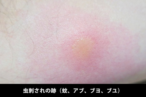 症例画像 虫刺されの症状・対処法 ひどい腫れや痒みも皮膚・爪・髪の病気All About