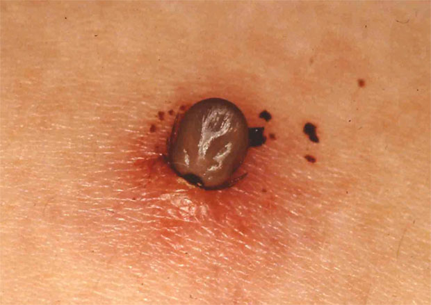 人生１００年クラブ：命に関わる感染症に 山林や草地、マダニ注意毎日新聞