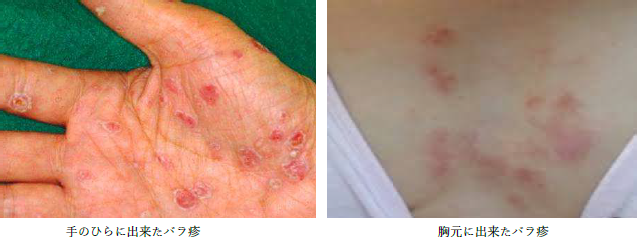 梅毒 - いかど腎泌尿器科クリニック・松本市