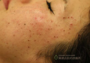 シミ肝斑治療外来 のシミ症例施術詳細シミ取りレーザー1回 16mm参考価格49,280円 ※施術当時 ※外用・内服別途副作用火傷、炎症、炎症後色素沈着する場合があります。 今日はシミ取りレーザー の症例をご紹介します。 シミ取りレーザーは光 IPL