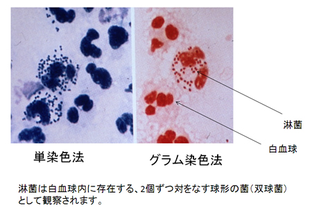 ひょう疽・爪周囲炎大田区大森・大木皮膚科 指の化膿でお困りなら