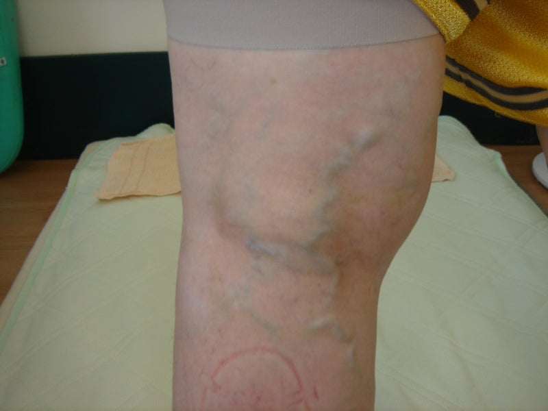 ベーカーのう胞とは？膝裏の腫れの原因・症状・治療法を解説 - ひとみるクリニックブログ