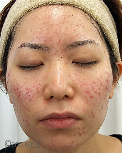 エステケアできるニキビ跡とできないニキビ跡の状態は？！和歌山県橋本市エステサロン 微細針美容でニキビケア＆痩身 よもぎ蒸しができるエステサロンシエスタ