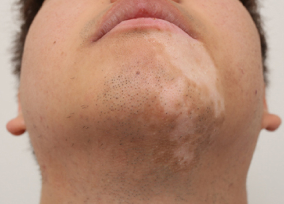 尋常性白斑とまだら症の重症度基準について - Genspark