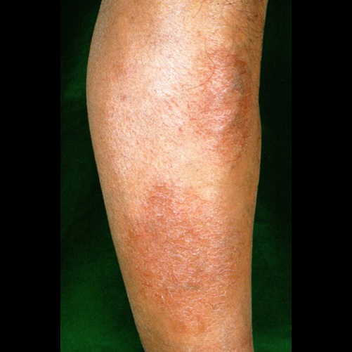 湿疹がある野田市 小児科 千葉県 こどもの花粉症 こどもの漢方 喘息 アトピー性皮膚炎 アレルギー 結節性痒疹 たんぽぽこどもクリニック