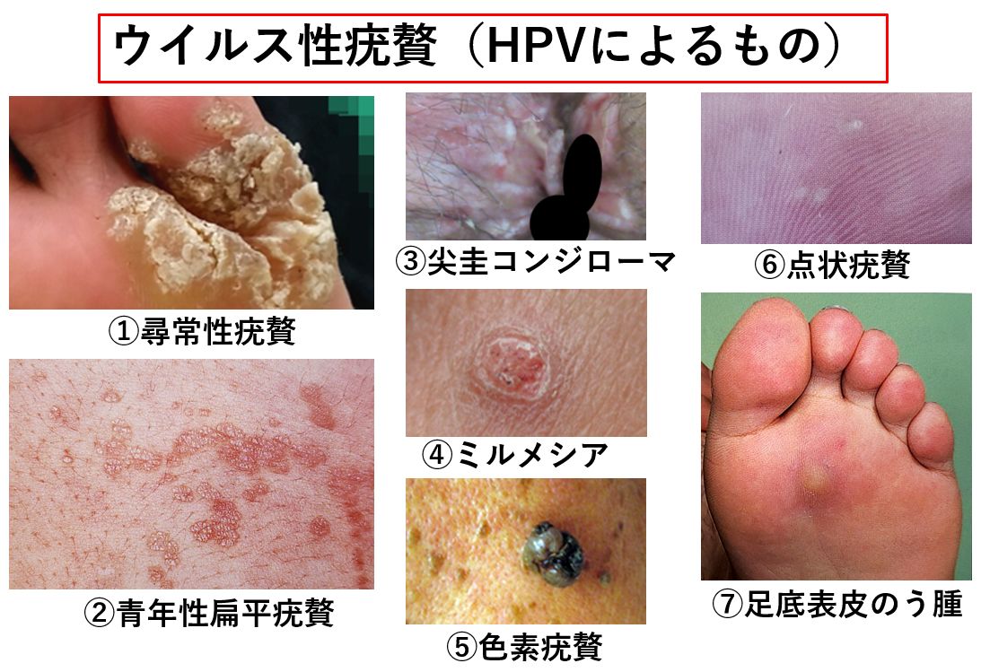 首イボのできる原因は？皮膚科で取る3つの除去方法 - 東京・大阪の美容皮膚科ならFLALU フラルクリニック