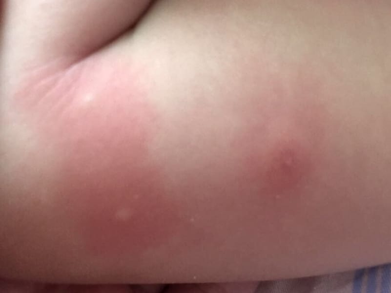 虫さされチェックアース害虫駆除なんでも事典