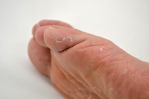 足だけではない？画像・写真でみる白癬 水虫 の種類と症状メディカルノート