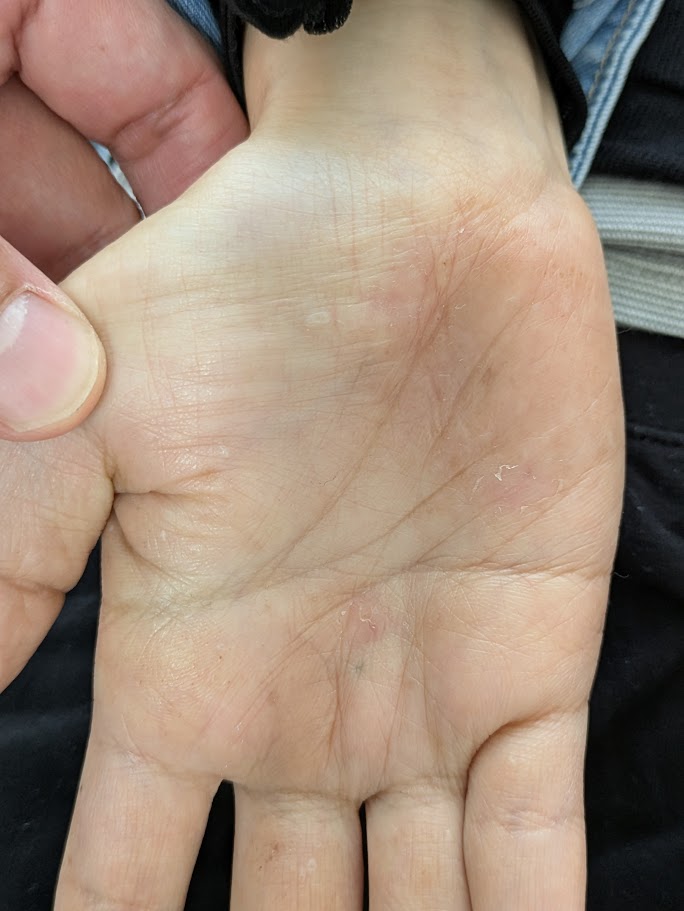 網状肢端色素沈着症の患者様が治療のために来院されました。 患者様からの声・メディア掲載・クリニックからのお知らせ名古屋Kクリニック