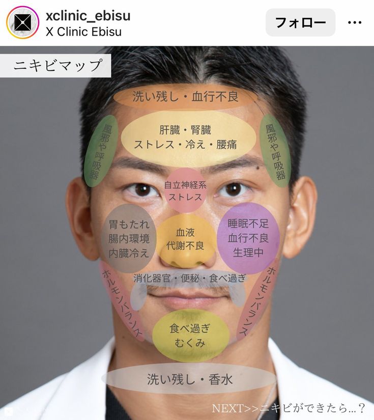 ニキビの場所で不調が分かる？🌼*・ - ホリスティックビューティーLohas