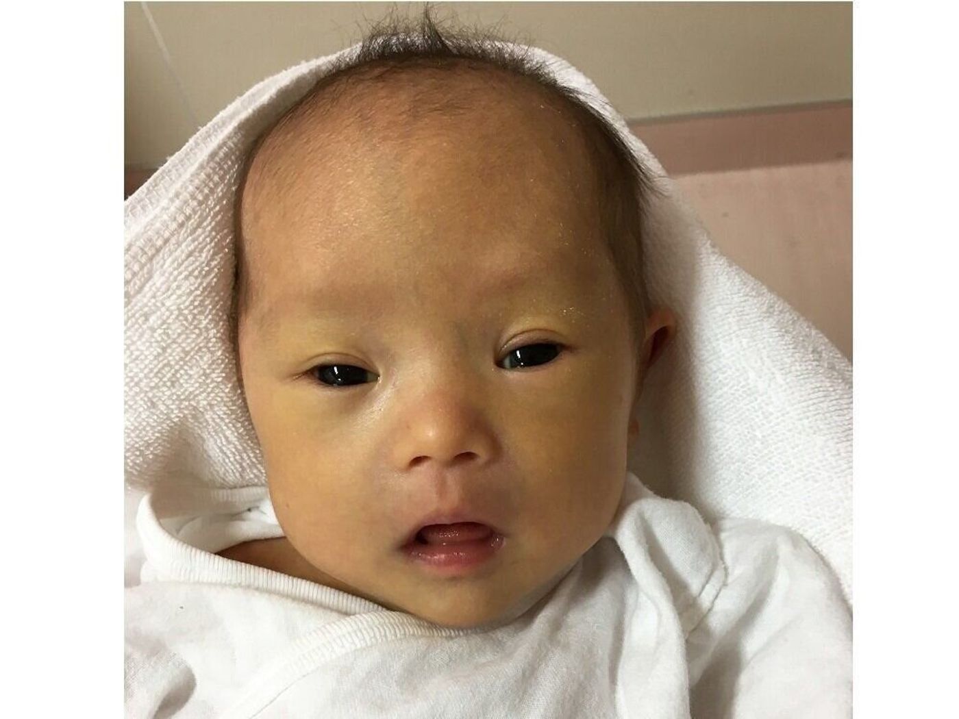 妊娠中のエコー写真21枚で指摘できる、ダウン症の予兆東京・ミネルバクリニック