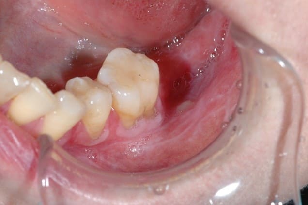 お口の中にカビの原因菌？「カンジタ菌」にご注意！ 訪問歯科事務局ブログ大阪・兵庫で訪問歯科なら健志会グループ