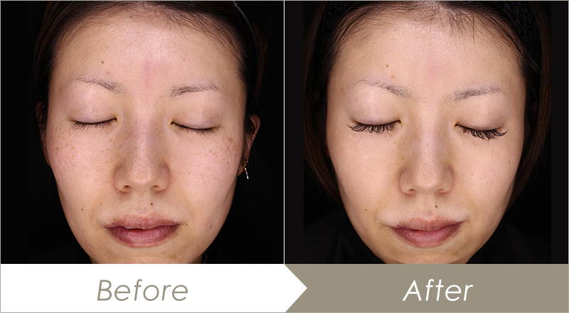 医療従事者監修 シミができやすい人の特徴はコレ！シミを予防・改善する方法はある？渋谷美容外科クリニック