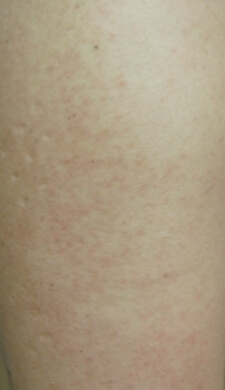 毛孔性苔癬埼玉県皮膚科医会